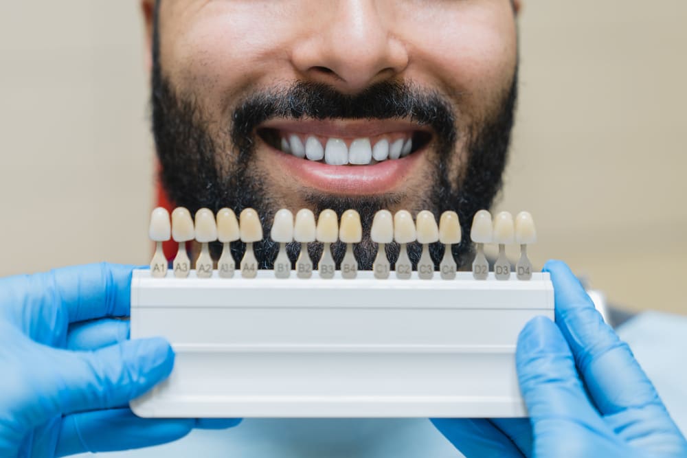 carillas dentales