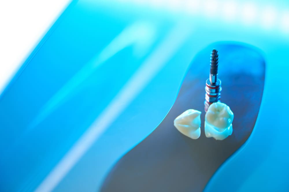 implantes dentales