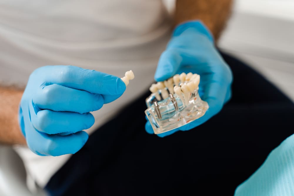 implantes dentales