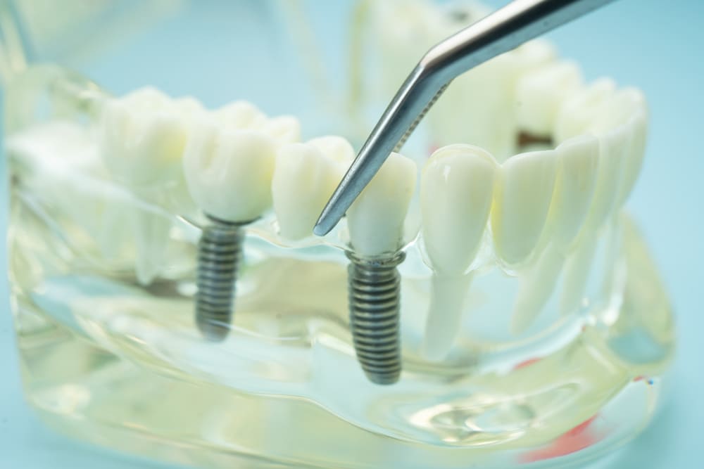 implantes dentales