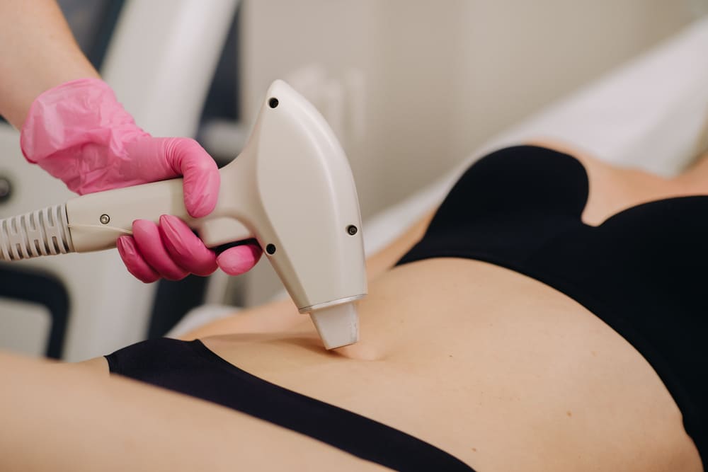 remodelación con laser