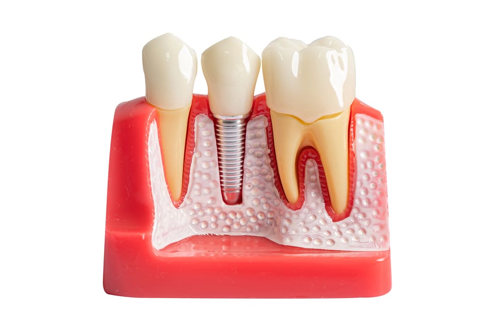 implante dental en Panamá