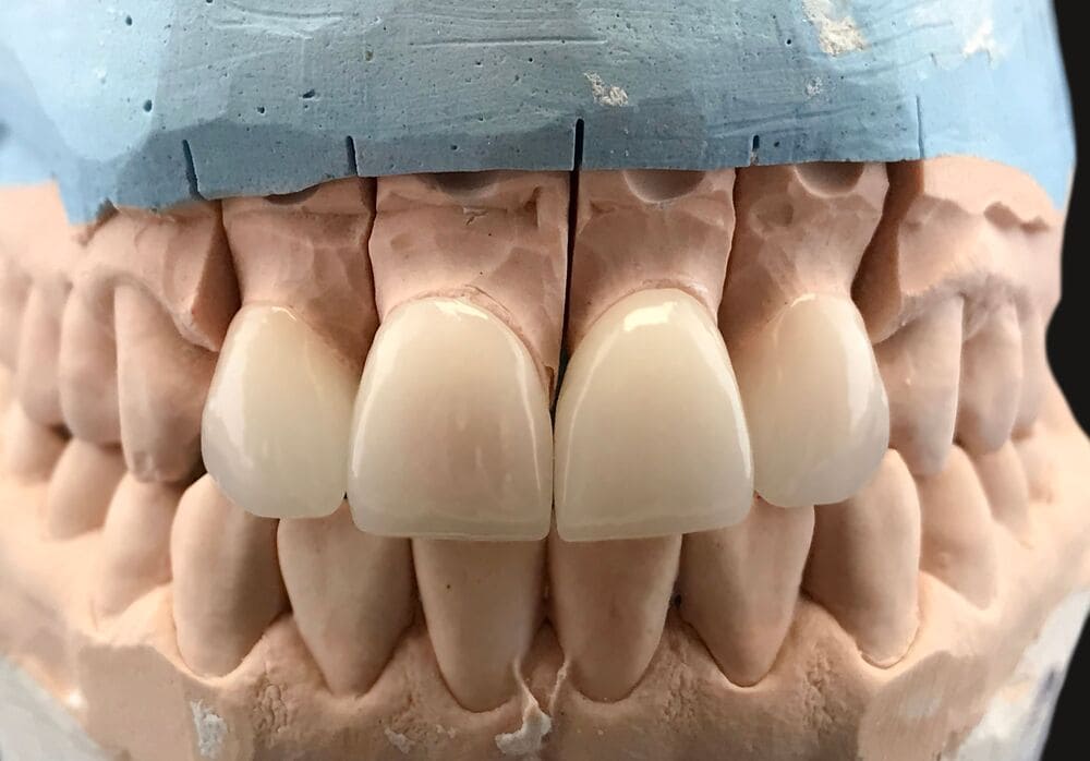 diseño de sonrisa en Panamá