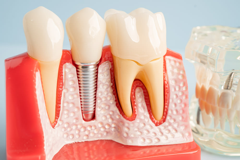 implante dental en Panamá