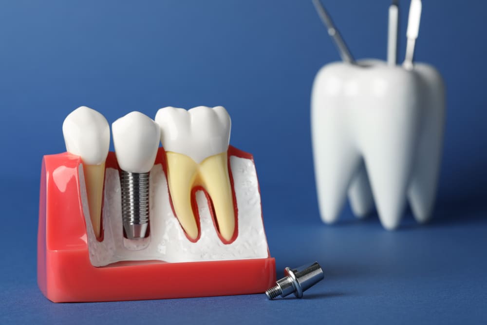implante dental en Panamá