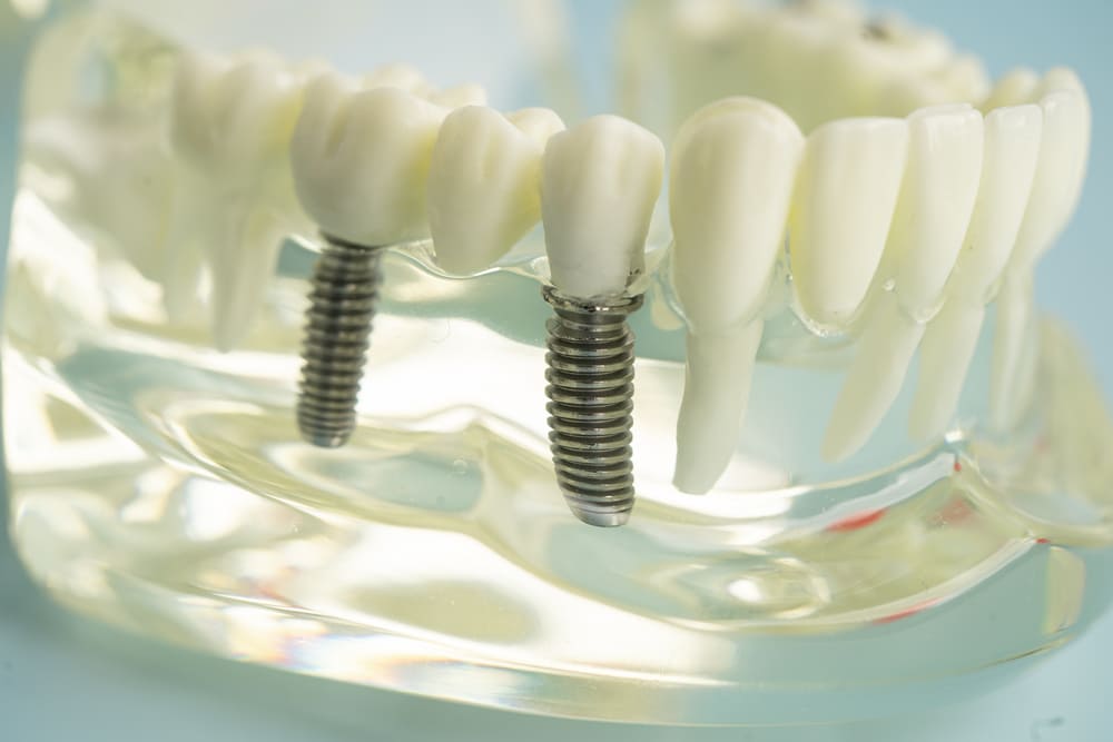implantes dentales en Costa del Este, Panamá