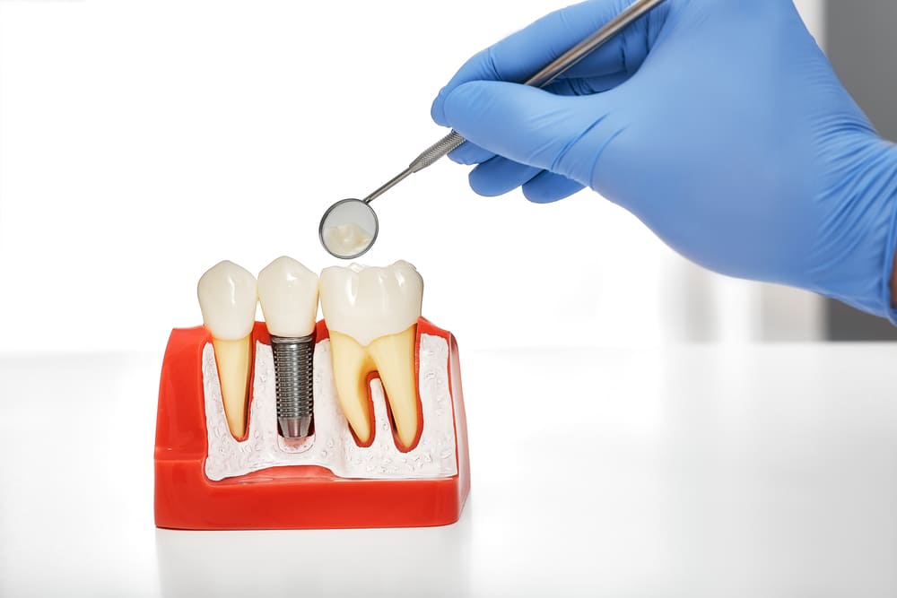 implantes dentales en Costa del Este, Panamá