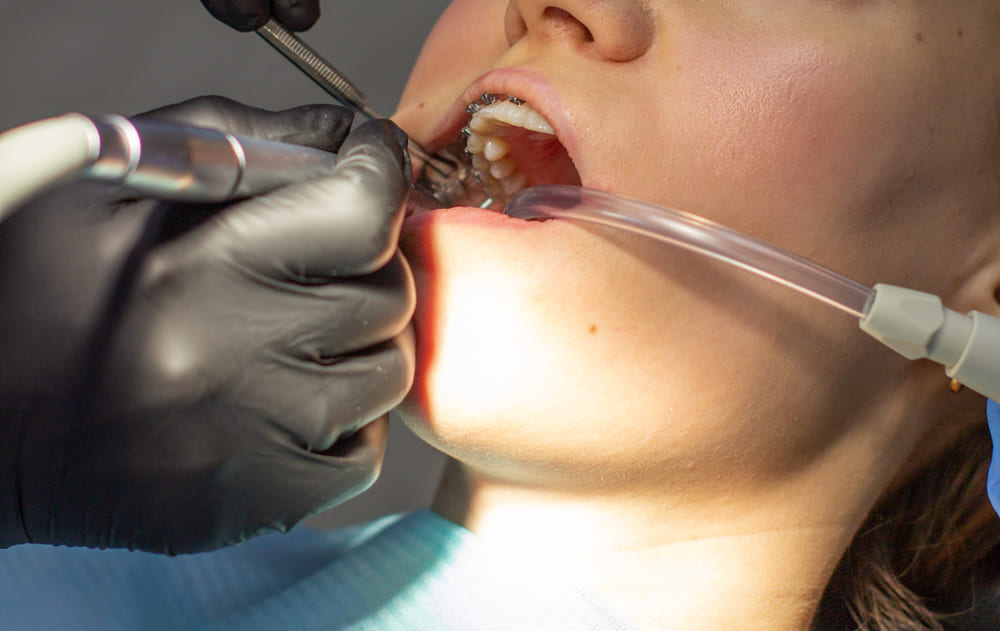 limpieza dental