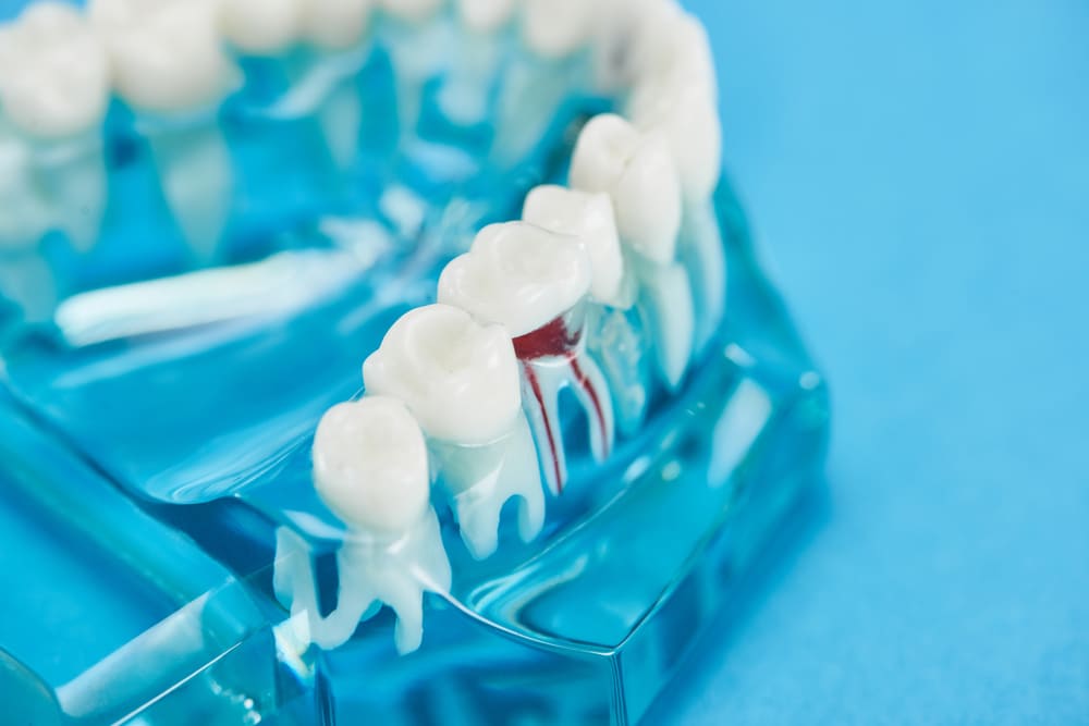 Endodoncia en Panamá: cuándo puede ayudar a salvar un diente