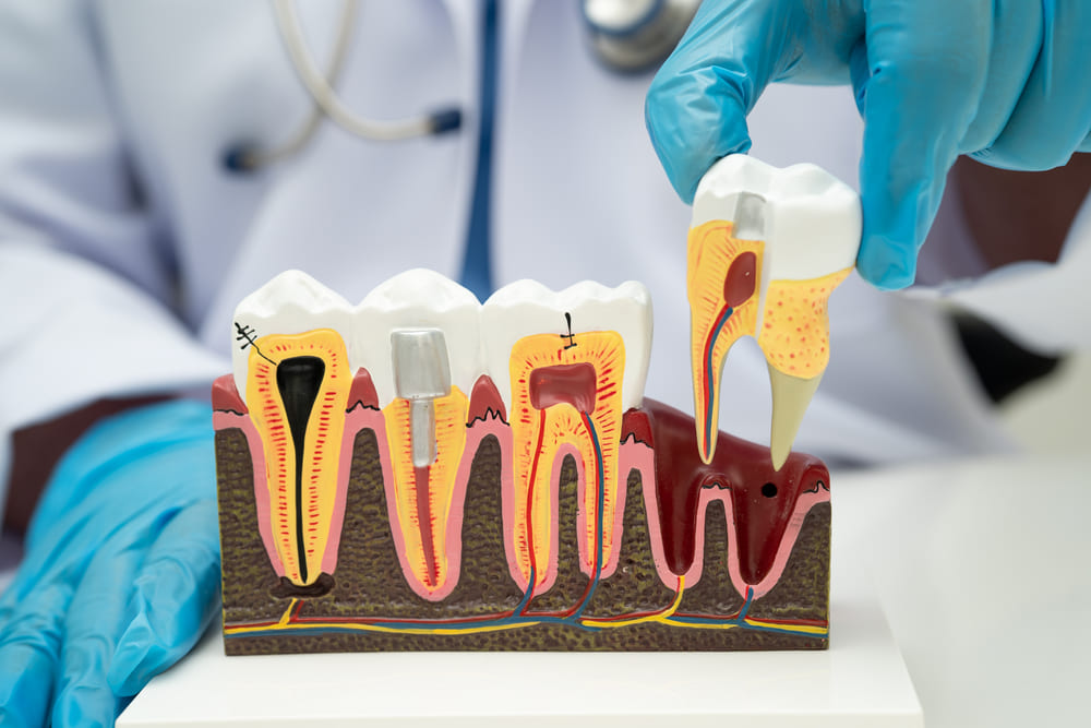Endodoncia en Panamá: cómo ayuda a conservar un diente afectado