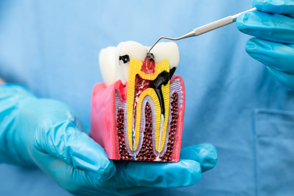 Cómo detectar problemas en las encías con periodoncia en Panamá